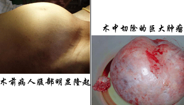 团队作战,妇科手术赋新篇