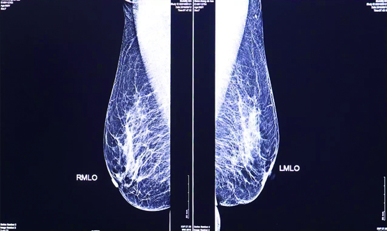 乳腺摄影的价值解读