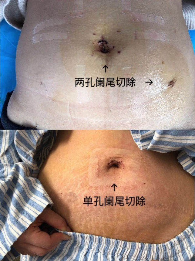 腹部手术不留痕    单孔技术显身手